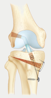 Osteotomie du tibia